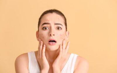 Más allá de la piel: El impacto emocional del acné